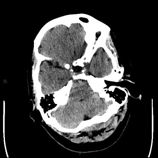 Cerebellar abscess (Radiopaedia 78135-90671 Axial non-contrast 27).jpg