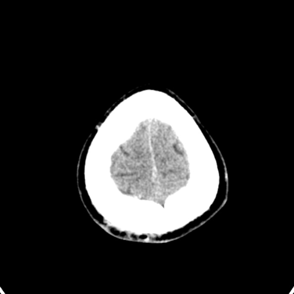 Cerebellar abscess secondary to mastoiditis (Radiopaedia 26284-26412 Axial non-contrast 146).jpg