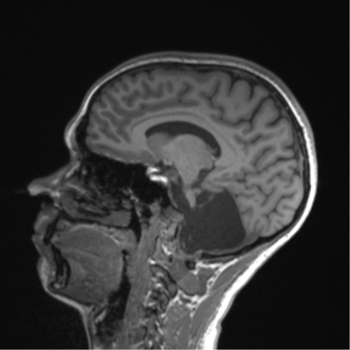Cerebellar agenesis with hypoplastic pons (pontocerebellar hypoplasia) (Radiopaedia 57224-64138 Sagittal T1 39).png