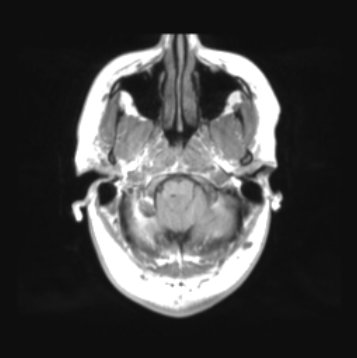 File:Cerebellar ependymoma complicated by post-operative subdural hematoma (Radiopaedia 83322-97736 Axial T1 8).png