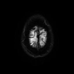 Cerebellar hemangioblastoma (Radiopaedia 29570-30077 Axial DWI 51).jpg
