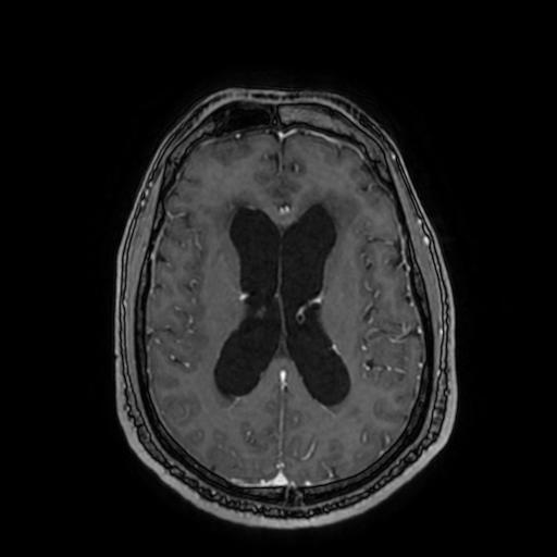 Cerebellar hemangioblastoma (Radiopaedia 88055-104622 Axial T1 C+ 107).jpg