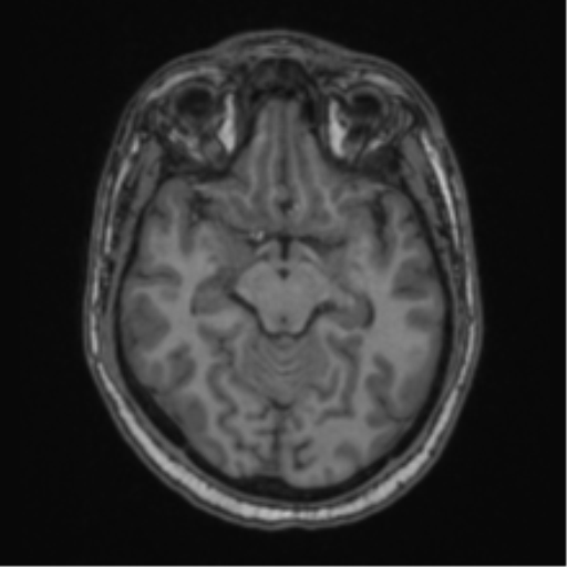 File:Cerebellar hemangioblastomas and pituitary adenoma (Radiopaedia 85490-101176 Axial T1 31).png