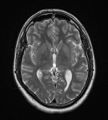 File:Cerebellar hemangioblastomas and pituitary adenoma (Radiopaedia 85490-101176 Axial T2 18).png