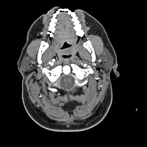 Cerebellar infarct due to vertebral artery dissection with posterior fossa decompression (Radiopaedia 82779-97029 C 61).png
