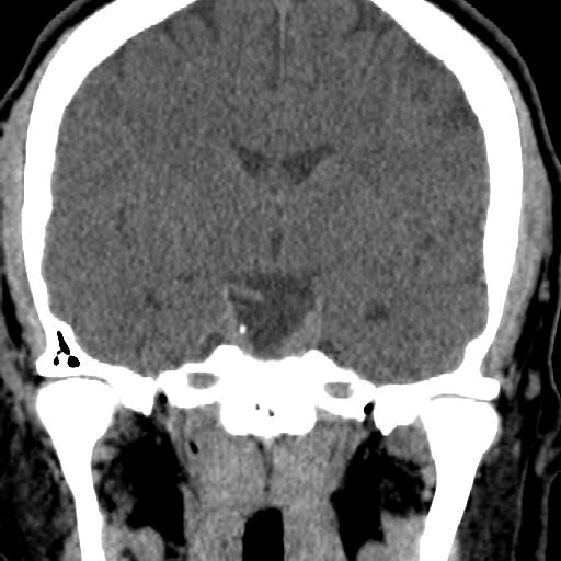 Cerebellar infarction (Radiopaedia 16625-16327 Coronal non-contrast 6).jpg