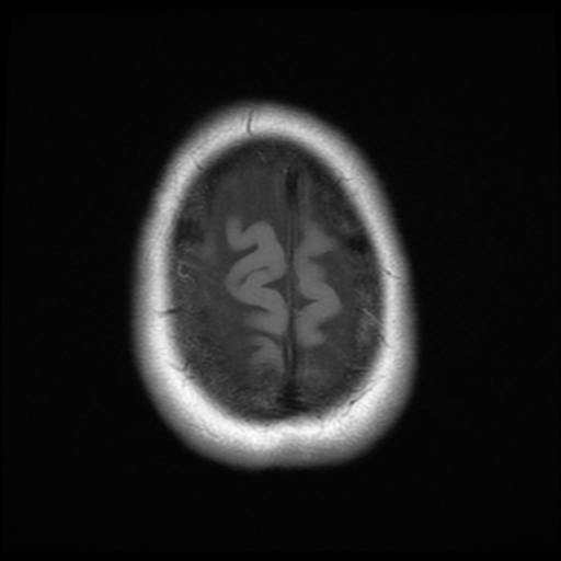 File:Cerebellar metastasis (cystic appearance) (Radiopaedia 41395-44268 Axial T1 22).png