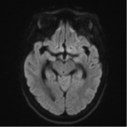 Cerebellar metastasis - adenocarcinoma lung (Radiopaedia 63184-71715 Axial DWI 41).png