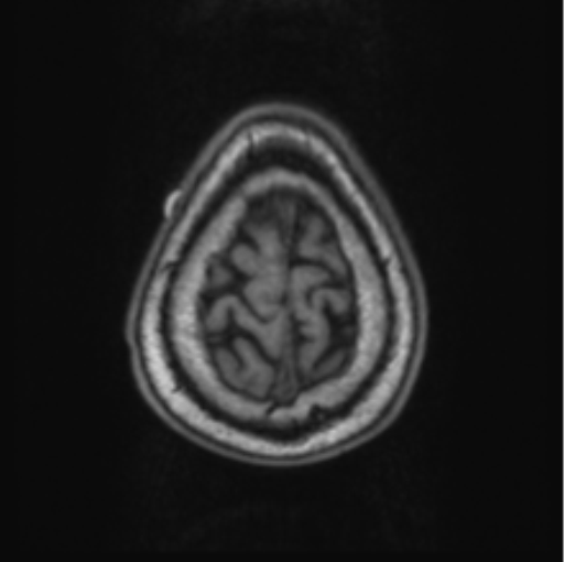 Cerebellar metastasis from lung adenocarcinoma (Radiopaedia 86690-102829 Axial T1 73).png