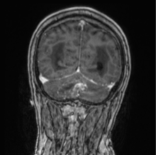 Cerebellar metastasis from lung adenocarcinoma (Radiopaedia 86690-102829 Coronal T1 C+ 23).png