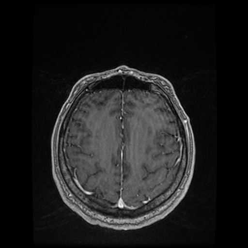 Cerebellar metastasis of pulmonary adenocarcinoma, cavernous venous malformation, and developmental venous anomaly (Radiopaedia 85827-101661 Axial T1 C+ 70).jpg