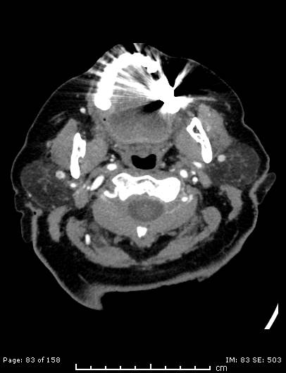 File:Cerebellar strokes due to intracranial giant cell arteritis (Radiopaedia 68799-78510 CT angiogram 83).jpg
