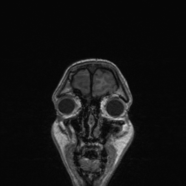 Cerebral abscess (Radiopaedia 24212-24478 Coronal T1 36).jpg