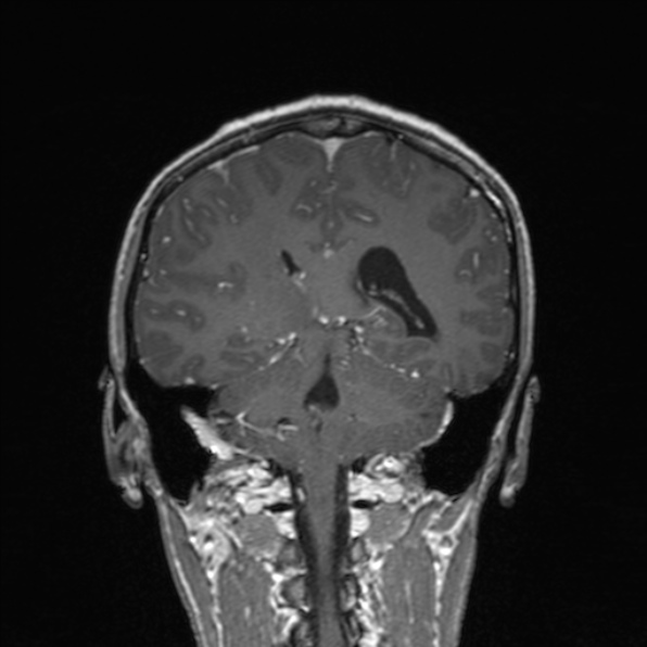 Cerebral abscess (Radiopaedia 24212-24478 Coronal T1 C+ 135).jpg