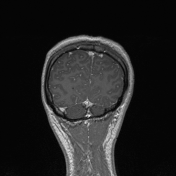 File:Cerebral abscess (Radiopaedia 24212-24478 Coronal T1 C+ 175).jpg
