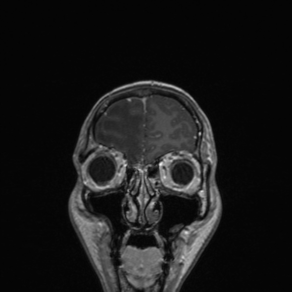Cerebral abscess (Radiopaedia 24212-24478 Coronal T1 C+ 45).jpg