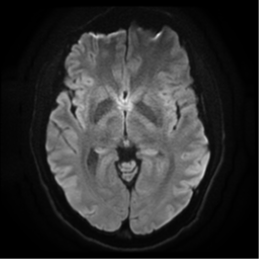 Cerebral abscess (Radiopaedia 57774-64740 Axial DWI 13).png