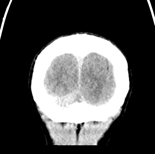 File:Cerebral abscess (Radiopaedia 60342-68008 Coronal non-contrast 59).png