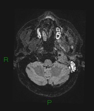 Cerebral abscess and subdural empyema (Radiopaedia 84436-99779 Axial FLAIR 70).jpg