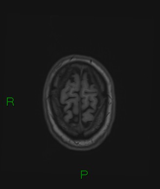 Cerebral abscess and subdural empyema (Radiopaedia 84436-99779 Axial T1 14).jpg