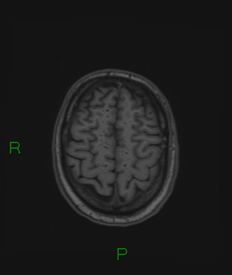 Cerebral abscess and subdural empyema (Radiopaedia 84436-99779 Axial T1 20).jpg