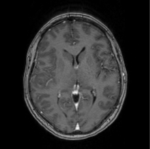 Cerebral abscess from pulmonary arteriovenous malformation (Radiopaedia 86275-102291 Axial T1 C+ 40).png