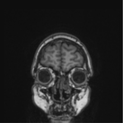 Cerebral abscess from pulmonary arteriovenous malformation (Radiopaedia 86275-102291 Coronal T1 80).png