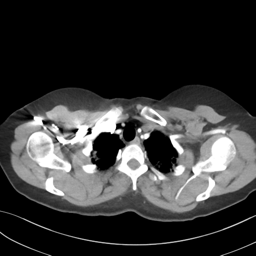 File:Cerebral abscess from pulmonary arteriovenous malformation (Radiopaedia 86275-102292 A 10).png