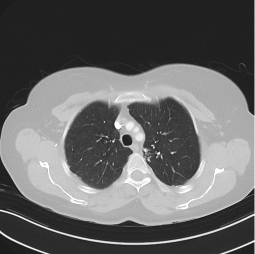 Cerebral abscess from pulmonary arteriovenous malformation (Radiopaedia 86275-102292 Axial lung window 18).png