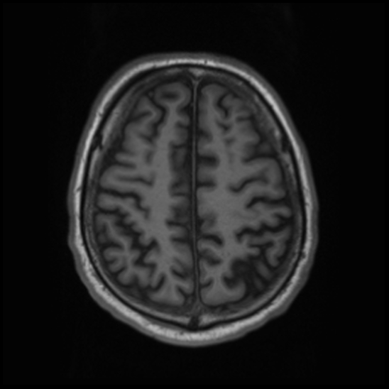 File:Cerebral abscess with ventriculitis (Radiopaedia 78965-91878 Axial T1 38).jpg