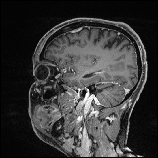 Cerebral abscess with ventriculitis (Radiopaedia 78965-91878 Sagittal T1 C+ 55).jpg