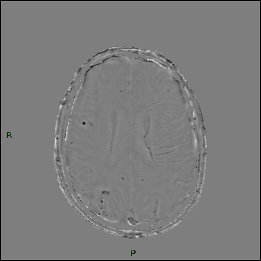Cerebral amyloid angiopathy (Radiopaedia 77506-89664 H 66).jpg