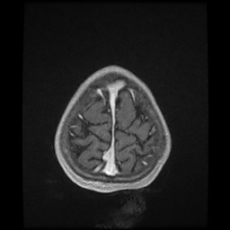 Cerebral and spinal tuberculosis (Radiopaedia 90489-107837 Axial T1 C+ 173).jpg