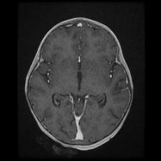 Cerebral and spinal tuberculosis (Radiopaedia 90489-107837 Axial T1 C+ 97).jpg