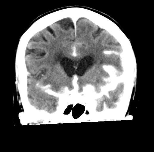 File:Cerebral aneurysm with rupture (Radiopaedia 29933-30460 Coronal non-contrast 14).jpg