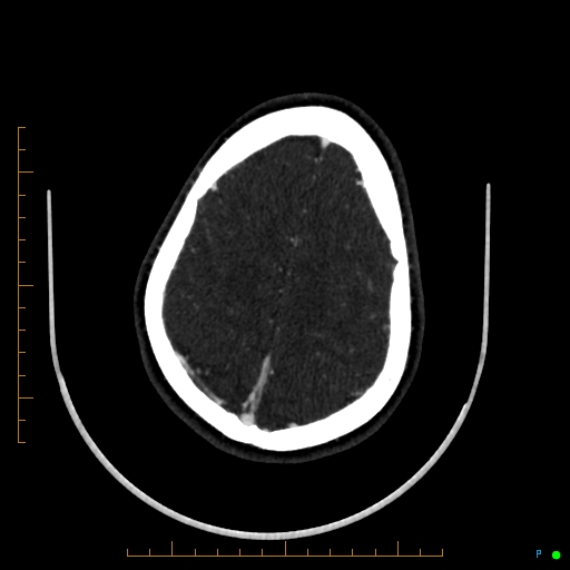 Cerebral arteriovenous malformation (AVM) (Radiopaedia 78162-90706 Axial CTA 221).jpg