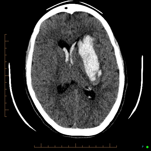 Cerebral arteriovenous malformation (AVM) (Radiopaedia 78162-90706 Axial non-contrast 36).jpg