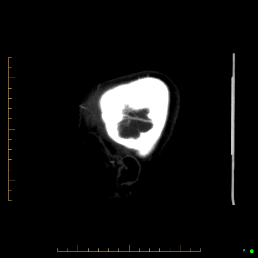File:Cerebral arteriovenous malformation (AVM) (Radiopaedia 78162-90706 Sagittal CTA 73).jpg