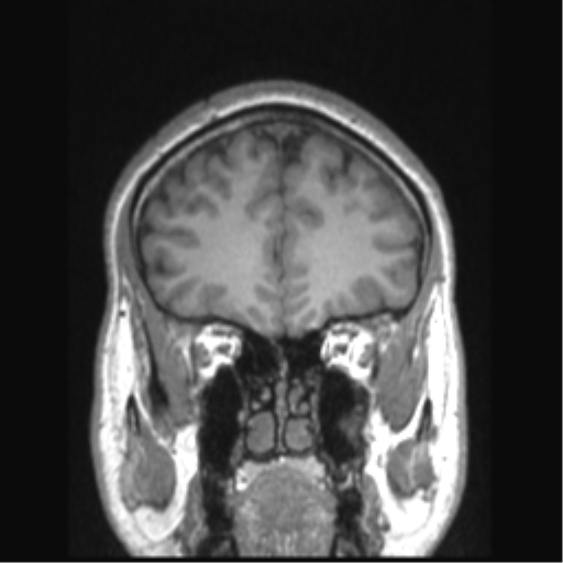 Cerebral arteriovenous malformation (Radiopaedia 39259-41506 Coronal T1 71).png