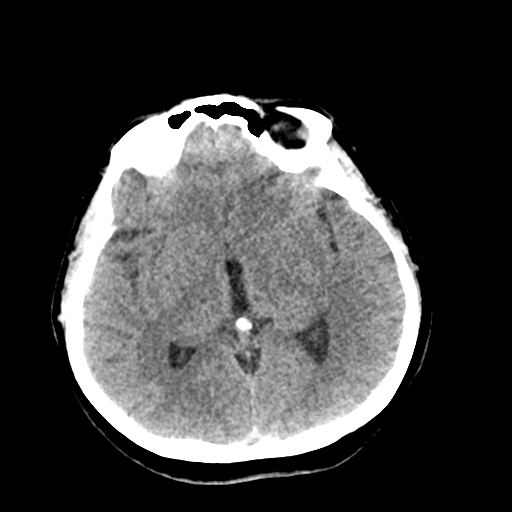 File:Cerebral arteriovenous malformation (Radiopaedia 73830-84645 Axial non-contrast 22).jpg