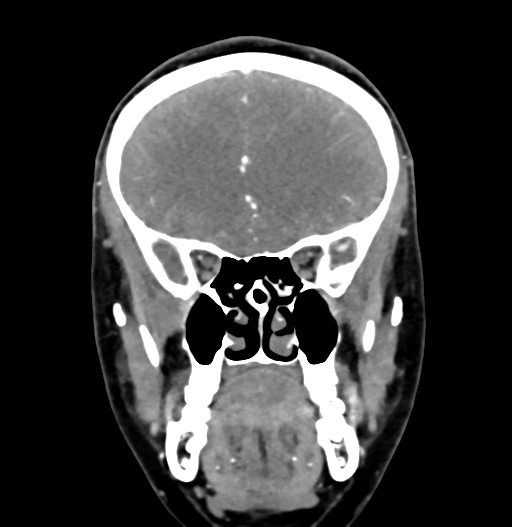 Cerebral arteriovenous malformation (Radiopaedia 73830-84645 C 30).jpg