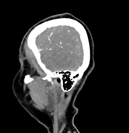 Cerebral arteriovenous malformation (Radiopaedia 73830-84645 D 81).jpg