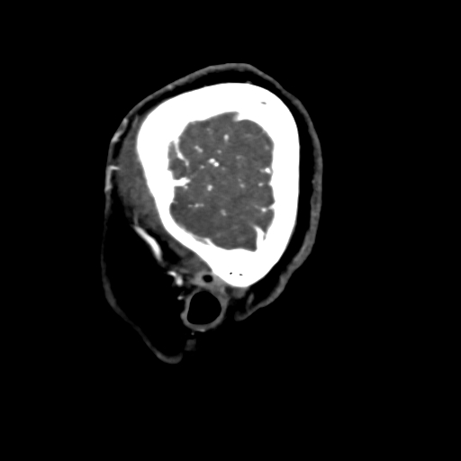 Cerebral arteriovenous malformation (Radiopaedia 73830-84645 Sagittal C+ delayed 6).jpg