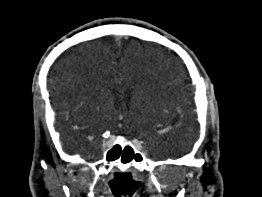 Cerebral arteriovenous malformation (Radiopaedia 78188-90746 Coronal C+ delayed 43).jpg