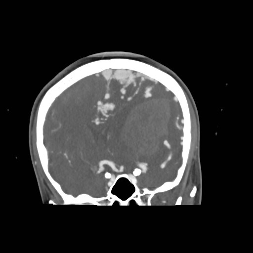 File:Cerebral arteriovenous malformation (Radiopaedia 79677-92888 B 14).jpg