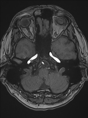 File:Cerebral arteriovenous malformation (Radiopaedia 84015-99245 Axial TOF 70).jpg