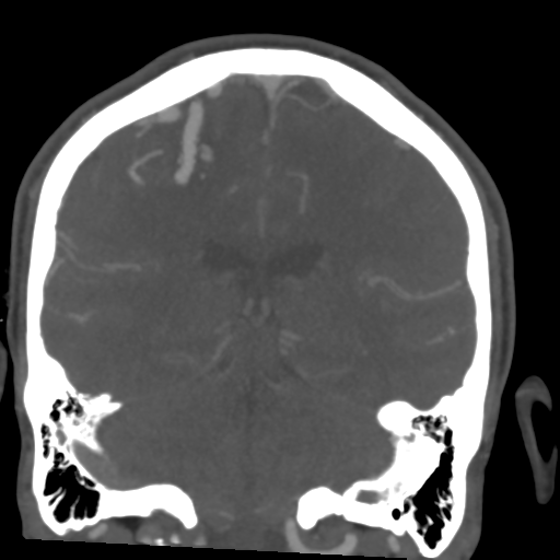 Cerebral arteriovenous malformation (Spetzler-Martin grade 2) (Radiopaedia 41262-44076 F 41).png