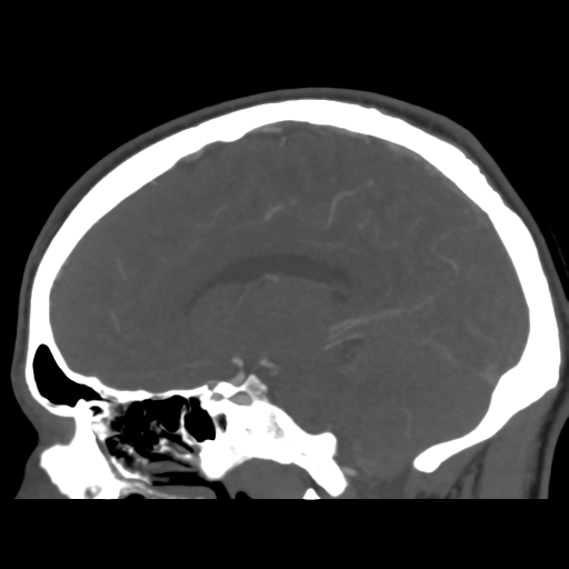 Cerebral arteriovenous malformation (Spetzler-Martin grade 2) (Radiopaedia 41262-44076 G 31).png