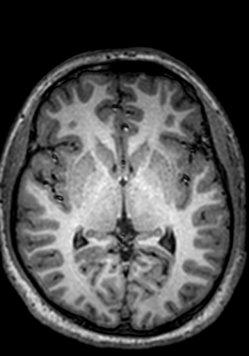 File:Cerebral arteriovenous malformation at posterior body of corpus callosum (Radiopaedia 74111-84925 Axial T1 149).jpg
