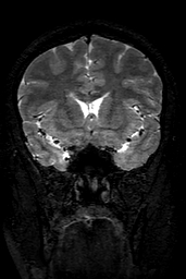 Cerebral arteriovenous malformation at posterior body of corpus callosum (Radiopaedia 74111-84925 Coronal T2 61).jpg
